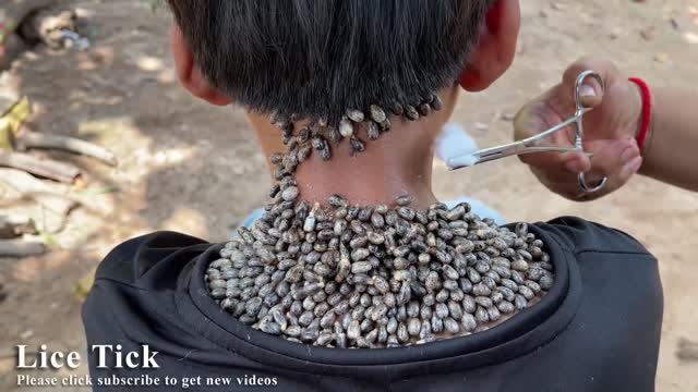 Oddly Satisfying Videos | Removing Tick on Human Body