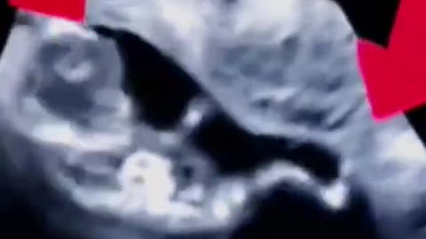 Ultrasound induced abortion