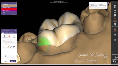 #design #naildesign #dental #dentaldesign #exocadexpert