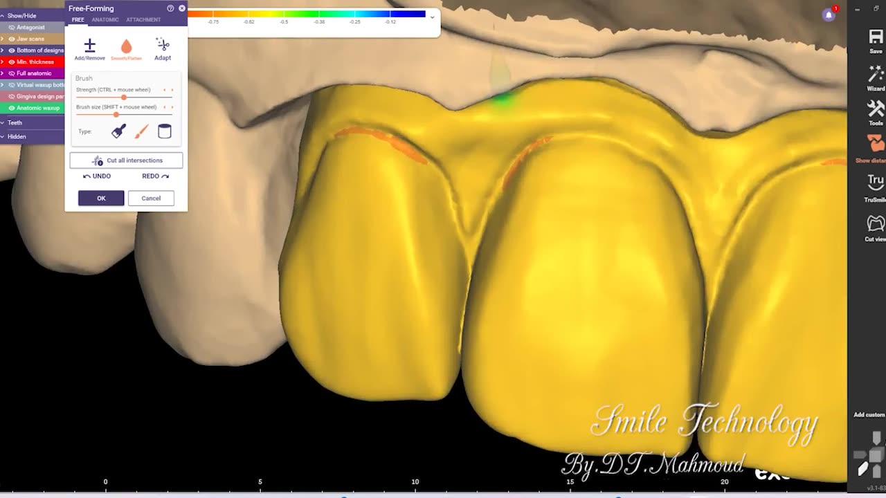 4 Unite Upper Teeth Design By Exocad