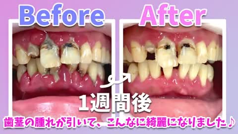 35 year old woman with swollen gums Tartar removal