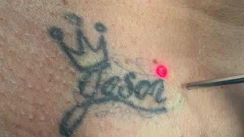 Tattoo Removal Journey x4