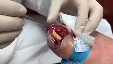 EXTREME Ingrown Nail Procedures Compilation | Dr. Kim, Kim Foot and Ankle