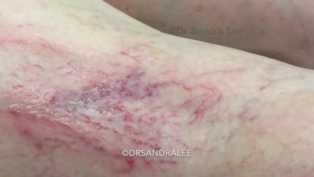 Sclerotherapy (treating spider veins) on the legs.