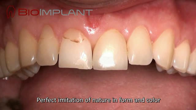 *** NATURAL DENTAL IMPLANT IN THE AESTHETIC ZONE PLACED IN 24 SECONDS***