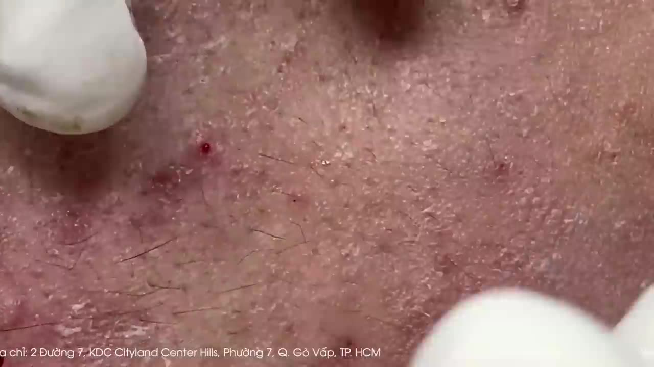 Big Cystic Acne Blackheads Extraction Blackheads & Milia, Whiteheads Removal Pimple Popping