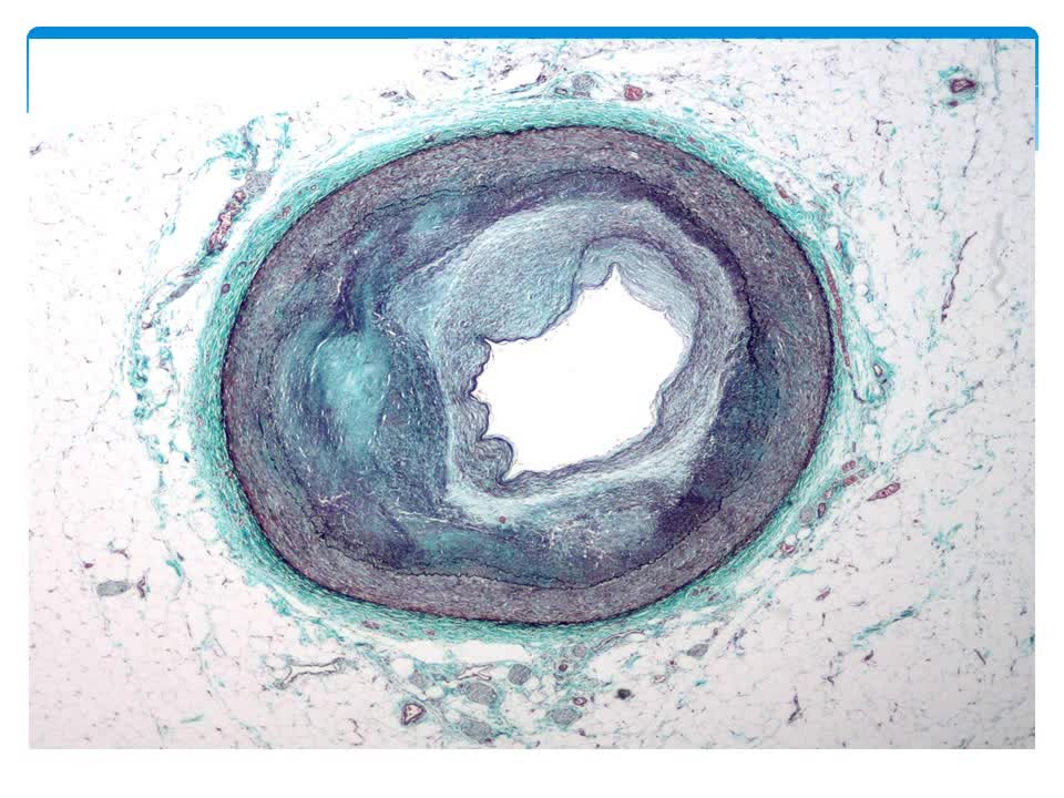 Atherosclerosis: Overview