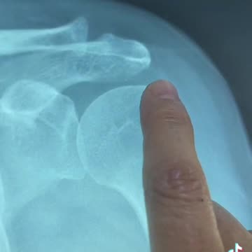 Dr Fredy Portillo y los dolores de hombro