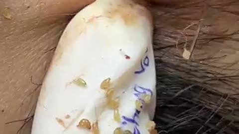 Viral satisfying blackheads removal