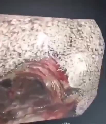 Graphene Oxide & Blood Clots