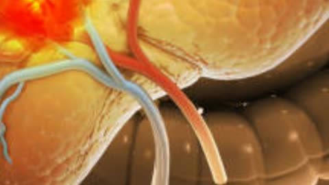 पीलिया क्या है -कारण,लक्षण,उपचार और बचाव