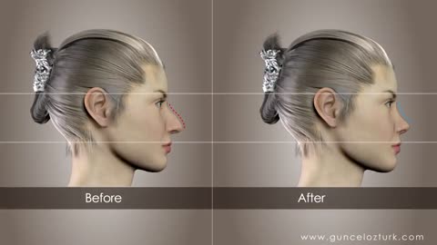 Rhinoplasty (Nose Job) Video Animation - Guncel Ozturk, MD - #DRGO