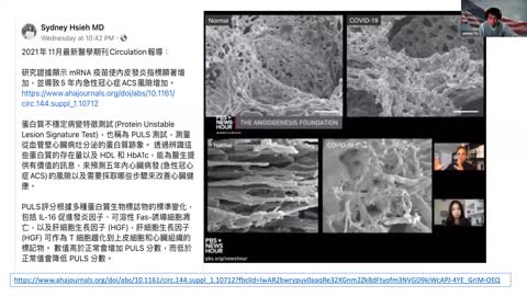 真理篇 （1）: 疫苗造成的自身免疫疾病及心肌炎 Vaccine Induced Myocarditis