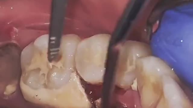 Do you routinely get scaling ? #satisfyingvideo