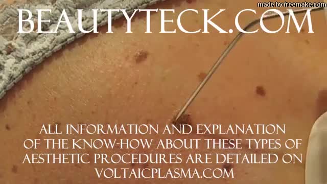 Keratosis removal example using the Plasma BeautyTeck Device