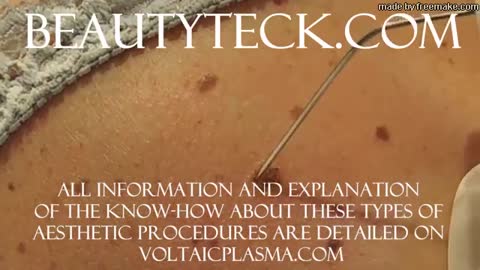 Keratosis removal example using the Plasma BeautyTeck Device