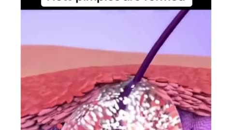 How pimples are formed