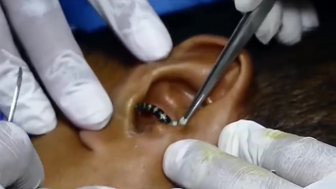 Horrible Bug remove from ear