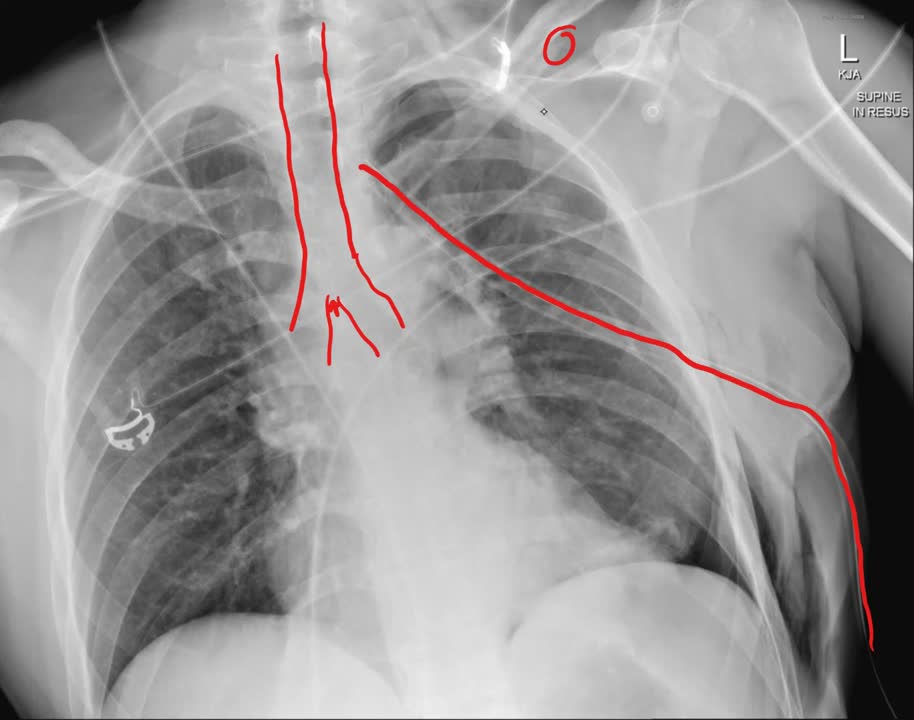 CXR tension pneumothorax