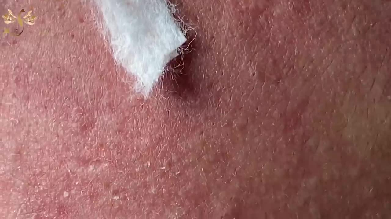 #092 | Acne Treatment Huong Beauty