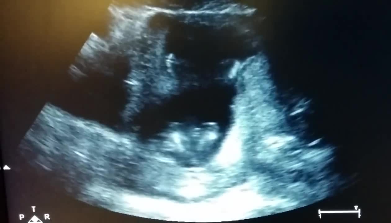 Baby clapping hands in the womb