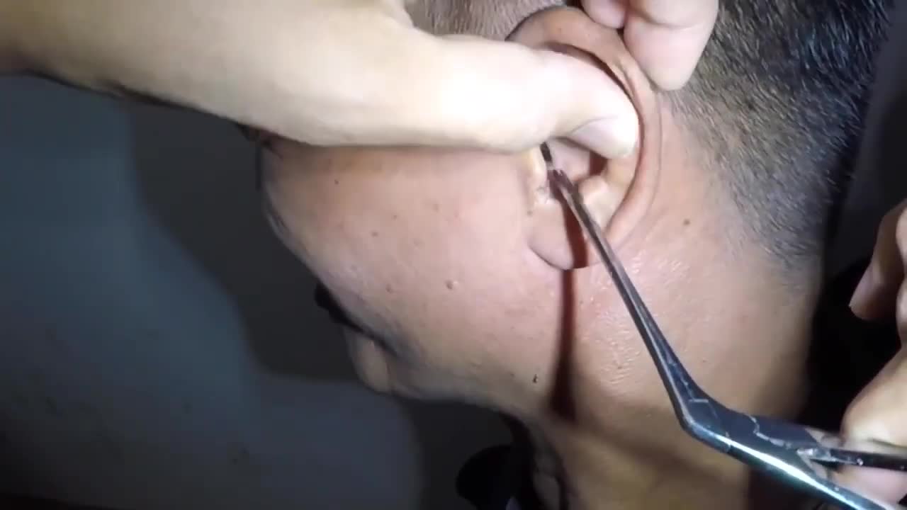 Bug removal from ear || EAR WAXING