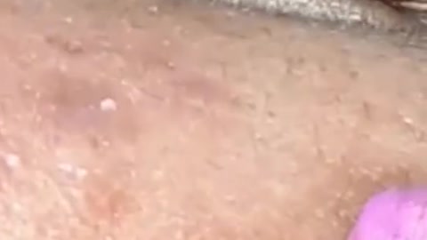 removing blackheads. relaxing video