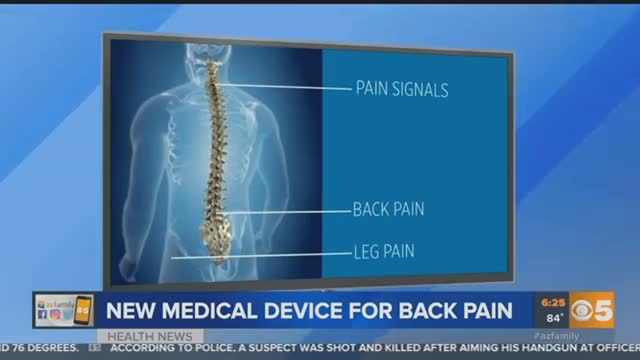 VIDEO A breakthrough medical device is helping control back pain