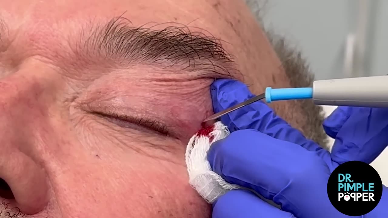 Acrochordon Snip Removal! Dr Pimple Popper REMOVES Skin Tags Near Eyes