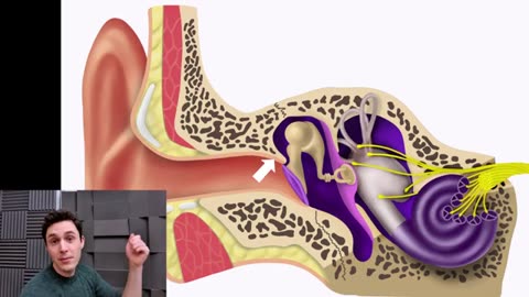 After_Cholesteatoma_Surgery_(Still_A_Problem_With_Effusion)