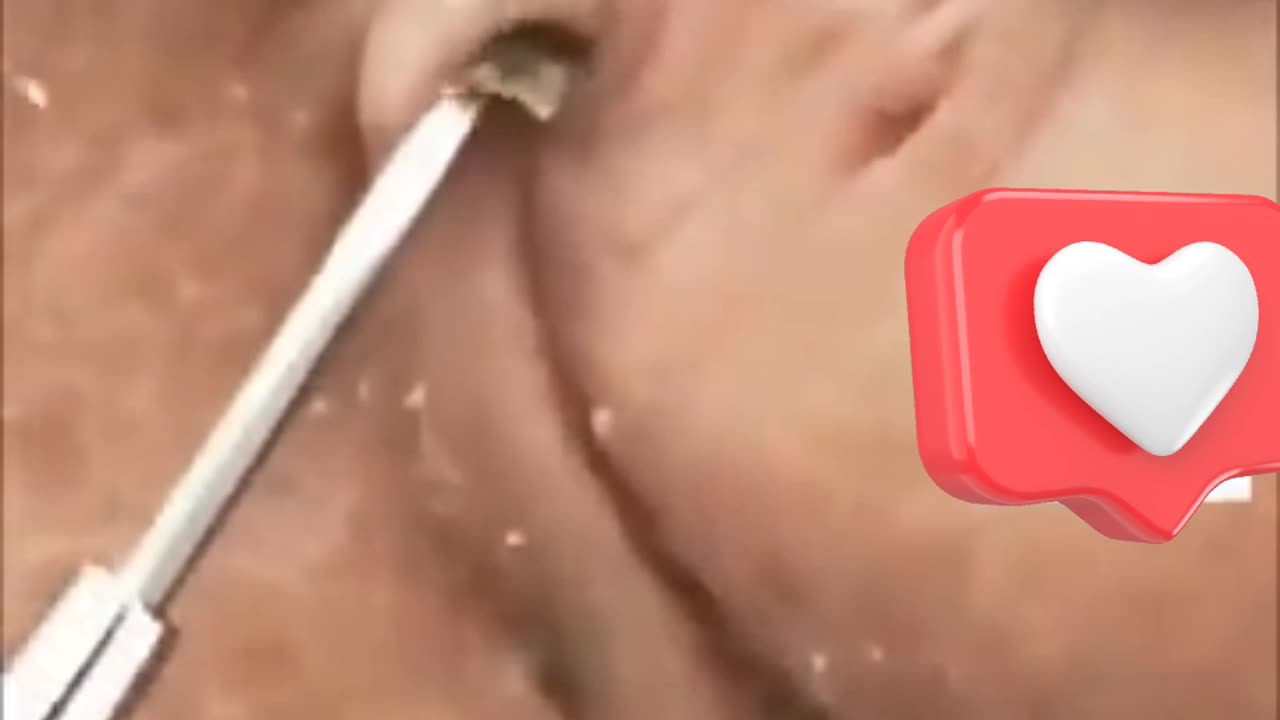 Blackhead in Ear