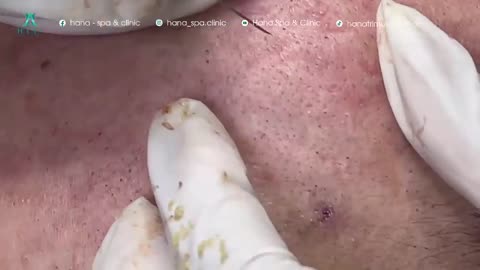 Big Cystic Acne Blackheads Extraction Blackheads