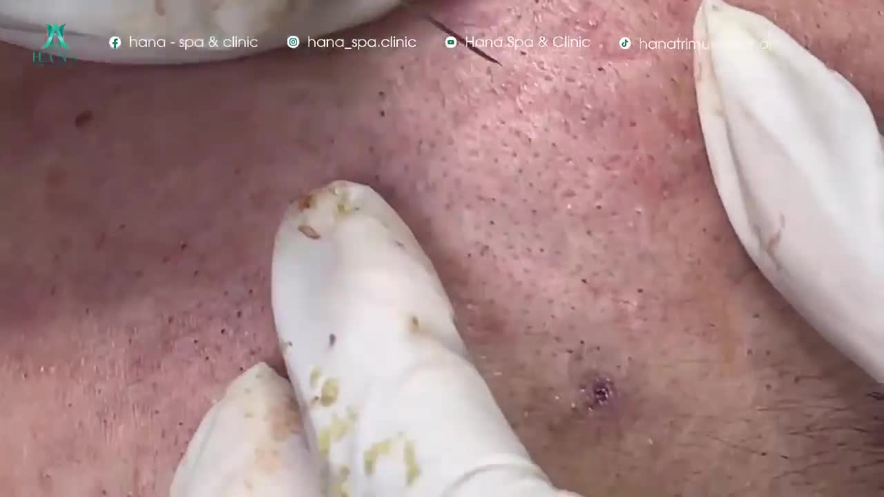 Big Cystic Acne Blackheads Extraction Blackheads