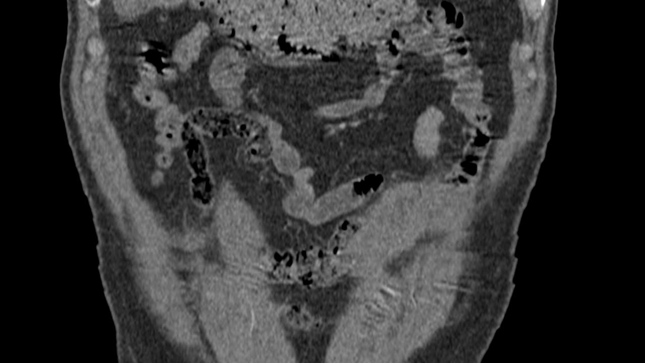 Thoracoabdominal CT angiography, coronal view