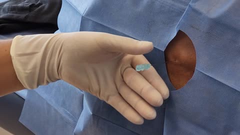 Prevent Alzheimers and Improve Brain Function with Intrathecal Stem Cell Therapy