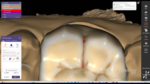 #design #naildesign #dental #dentaldesign #exocadexpert