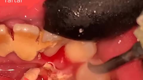 Tartar Dentist 2021 | Satisfying Dental-work
