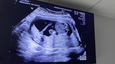 Week 17 Ultrasound, April 28, 2022 Pt. 2