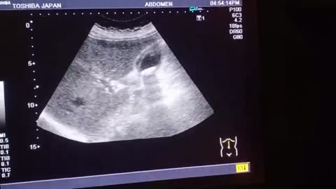 Gallstones With Thick Walled Gallbladder l With Heart Disease l Cholecystitis l