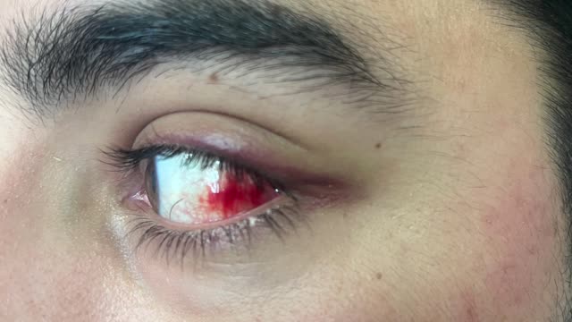 Eye Hemorrhage Pr