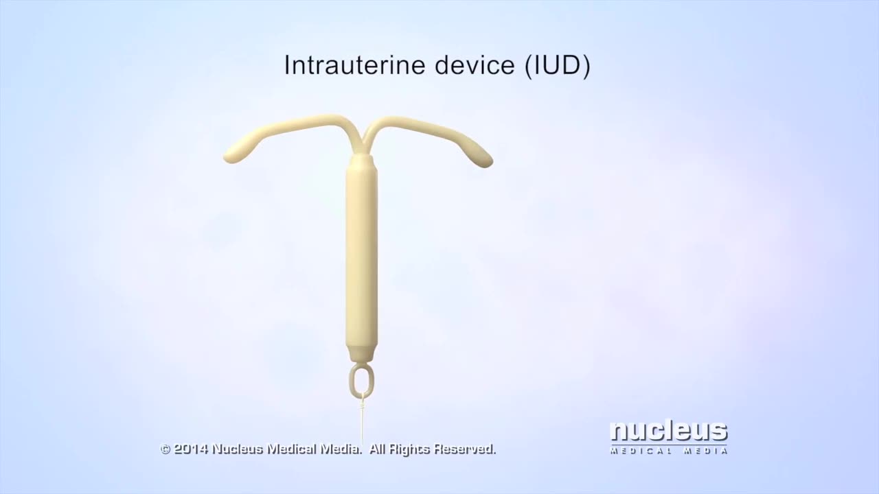 What is an IUD