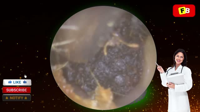 Ear Wax Removal PART 5