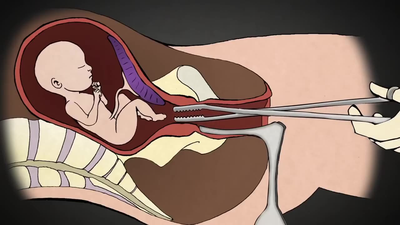 Prevent Abortion