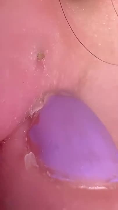 Relax Satisfying - にきびの除去とにきびの飛び出し #Shorts