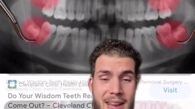 The truth on why they remove the wisdom teeth