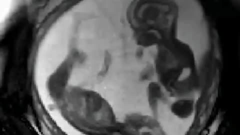 Mri fetal scan twin pregnancy ☢️♥🥰