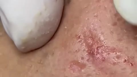 Blackheads & Milia, Big cystic acne blackheads extraction whiteheads Removal Pimple Popping.