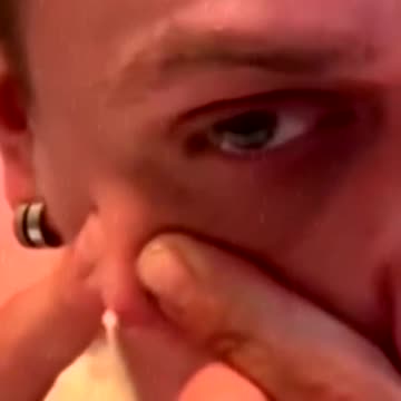 EXPLOSIVE CYSTS PIMPLE POPPING CYST SKIN PART# 15 _ EXPLOSIVOS QUISTES SEBACEOS 😷🎵