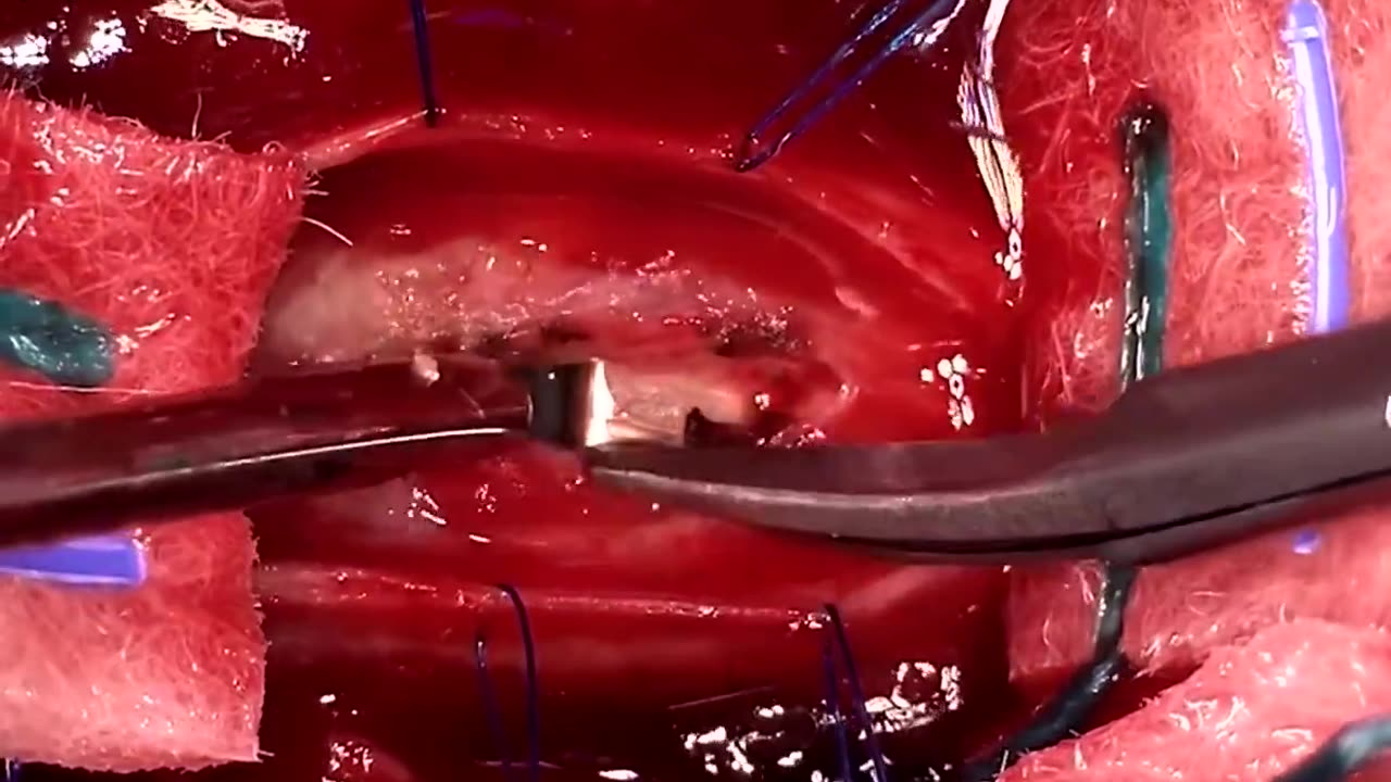 Amazing work by Neurosurgeons to remove Bullet from the spinal cord