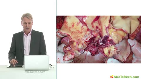 9. TEE on the ICU and After Cardiovascular Surgery TEE and CV Surgery - Part 2
